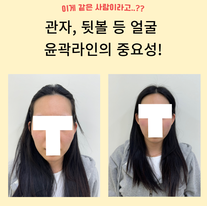뒷볼꺼짐,옆볼꺼짐,관자꺼짐아 ~ 통통하게 차올라라 얍 ! 맑고고운시그니처의 래디어스 콜라겐필러